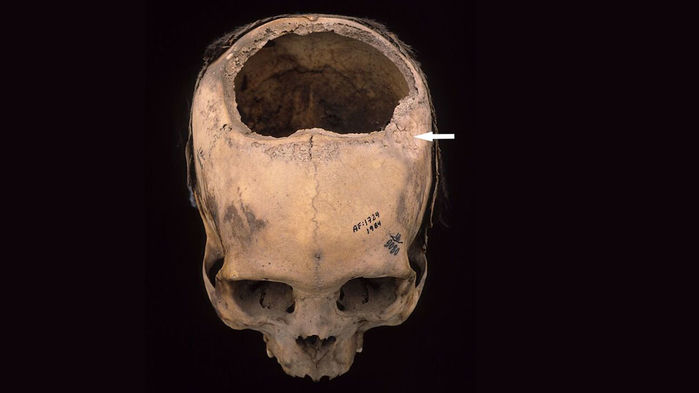 Trepanation perou