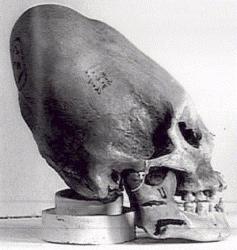 alien-ufo-extraterrestrial-face-head-skull-bone-anomalies-elongated-cranium-0-central-america-tribes-bind-infant-skulls-for-this-result.jpg