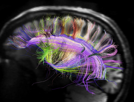 Cerveau irmd 1