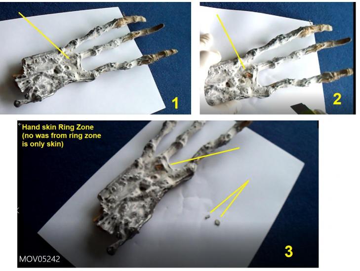 Hand skin ring zone