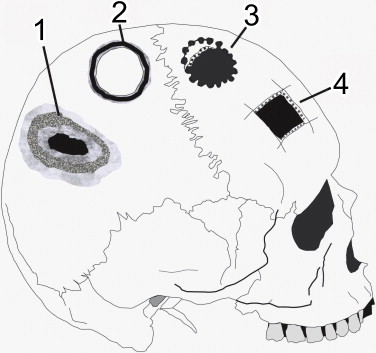 Trepanations au perou methodes